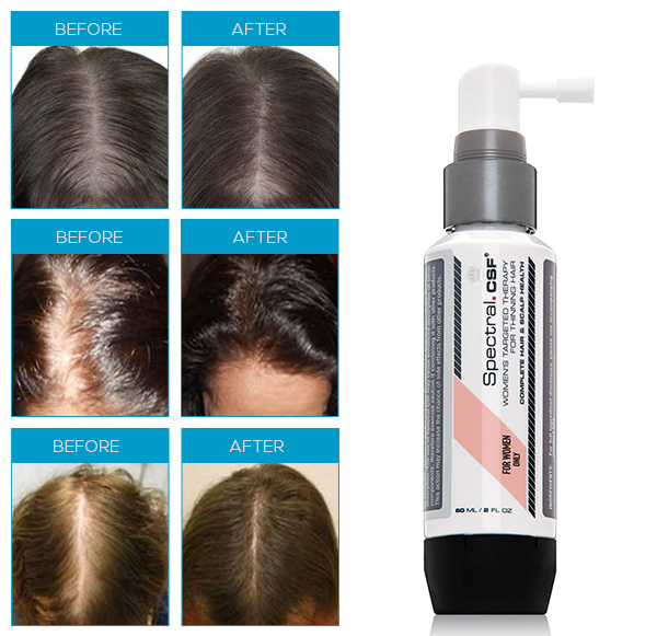 Spectral csf, 스펙트랄, DS래보래토리즈, 나녹시딜, 나녹시딜액, 나녹시딜액2%, 나녹시딜액3%, 나녹시딜액5%, 앞머리탈모, 여자앞머리탈모, 여성탈모, 여성앞머리탈모, 앞머리 탈모, m자 탈모, m자형 탈모, 눈썹탈모, 눈썹탈모증