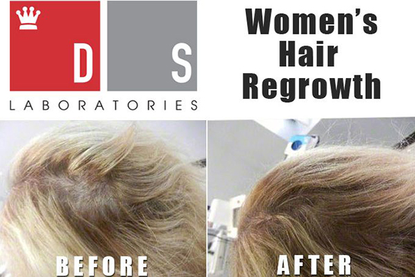 Spectral csf, 스펙트랄, DS래보래토리즈, 나녹시딜, 나녹시딜액, 나녹시딜액2%, 나녹시딜액3%, 나녹시딜액5%, 앞머리탈모, 여자앞머리탈모, 여성탈모, 여성앞머리탈모, 앞머리 탈모, m자 탈모, m자형 탈모, 눈썹탈모, 눈썹탈모증