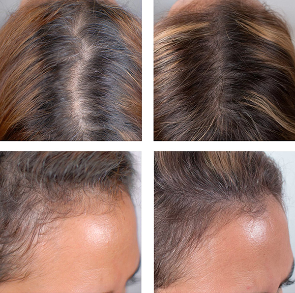 미녹시딜, 여성용 미녹시딜, 여성용 로게인, 여성로게인, 여성 로게인, 여성미녹시딜, 미녹시딜 구입처, 미녹시딜 효과, 미녹시딜 5%, 미녹시딜 3%, 미녹시딜 후기, 미녹시딜 사용법, 미녹시딜 부작용, 미녹시딜 가격, 여성탈모, 여성탈모치료제, 여성용 탈모, 여성용 탈모치료제, women's rogaine, women's minoxidil, women's minoxidil 5%, women's rogaine foam